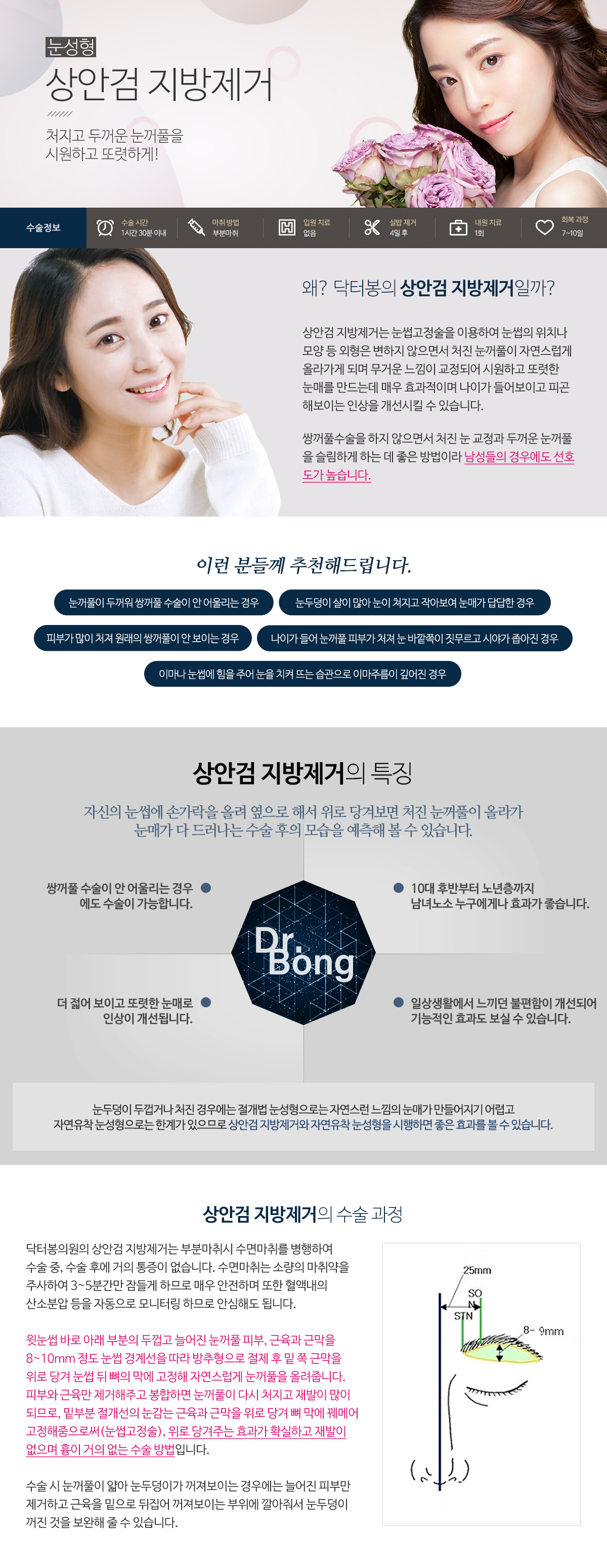 상안검3