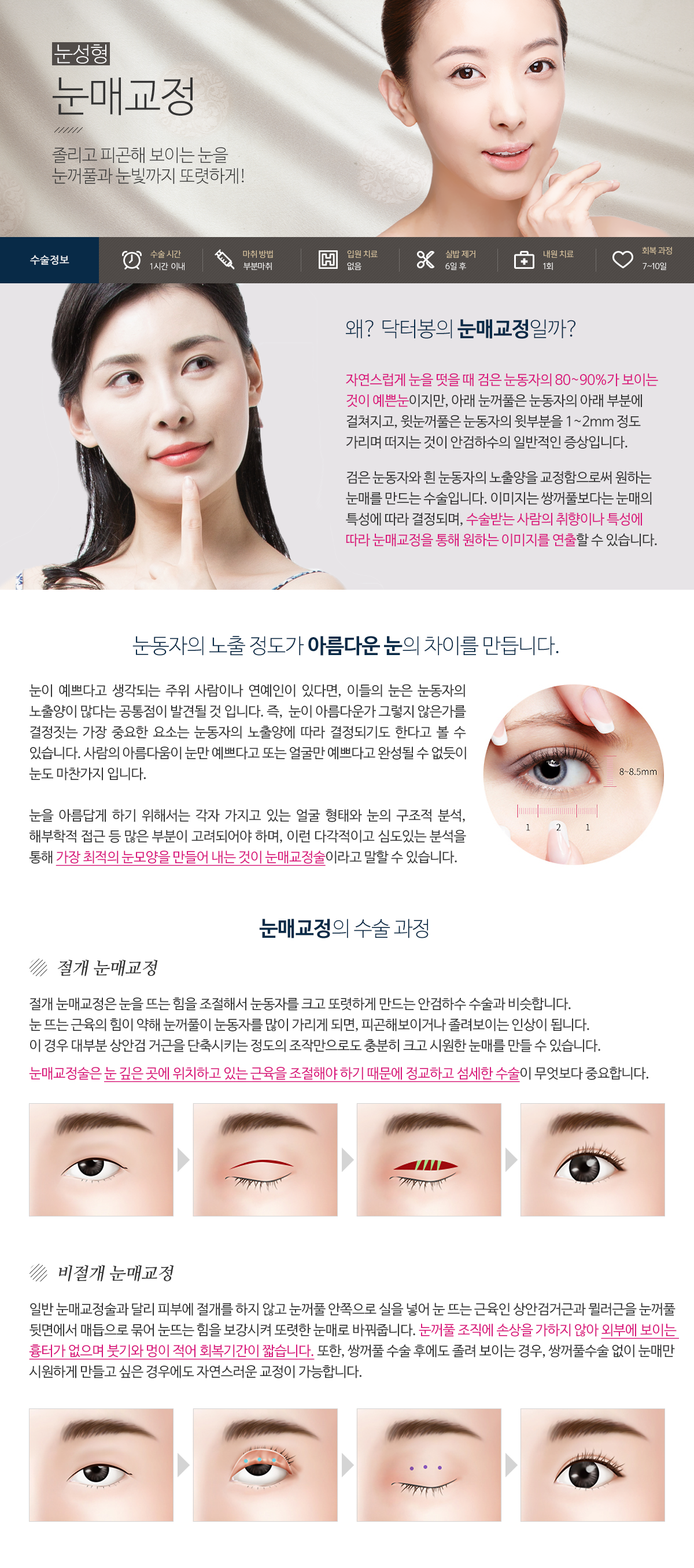 눈매교정